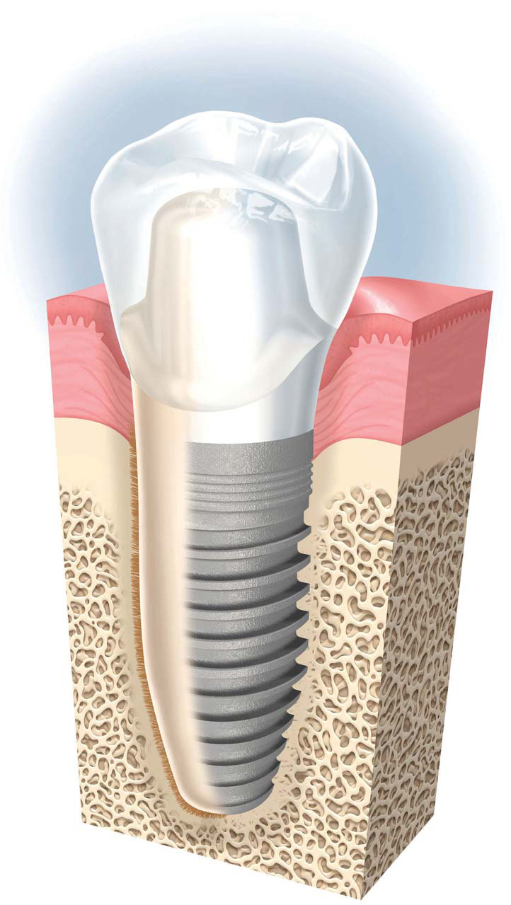 Crown on single implant