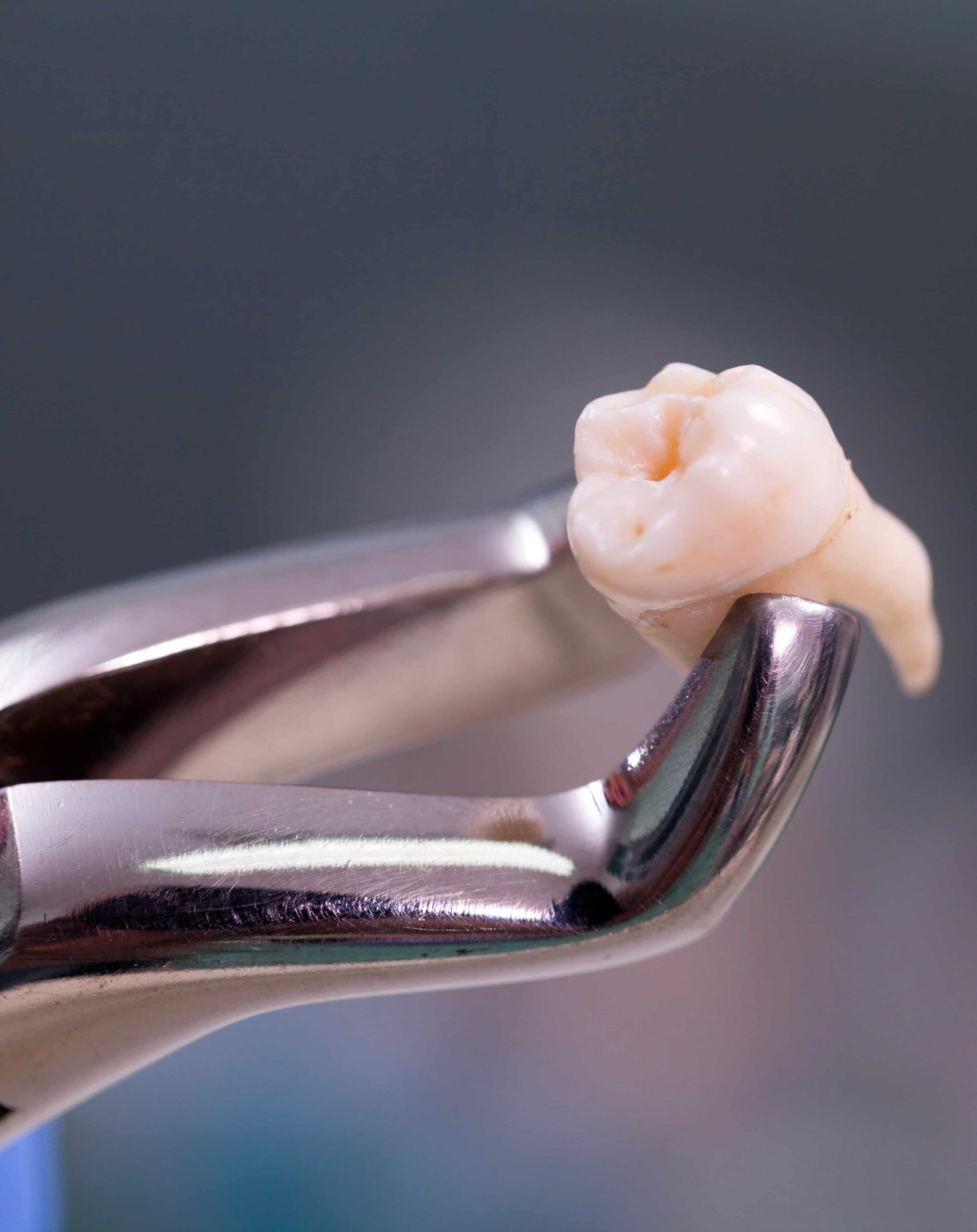 Simple Extraction Simple Extraction