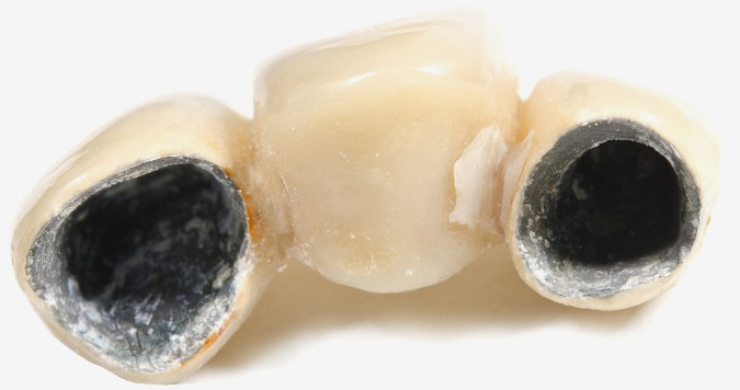 Placement of the crown