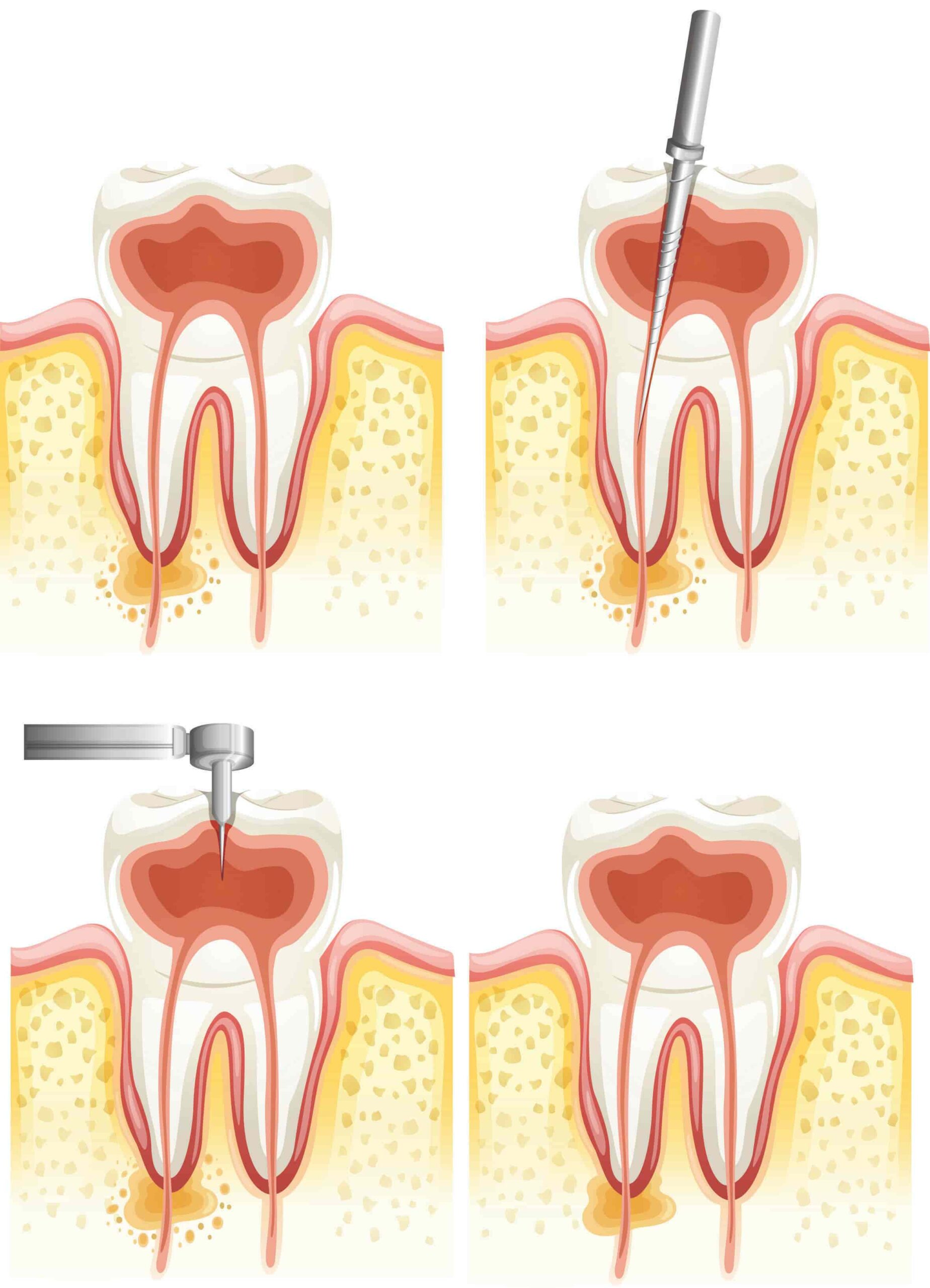 Root Canal Treatment