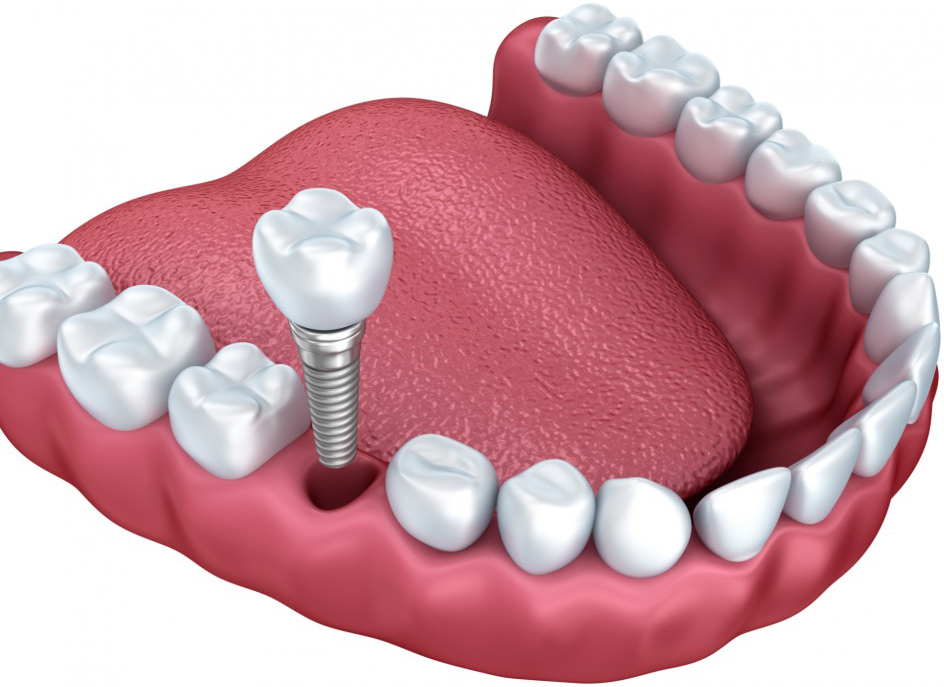 Taux de succès et longévité des implants dentaires